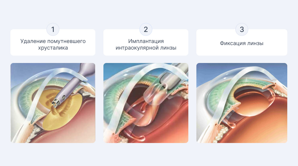 Этапы операции катаракта