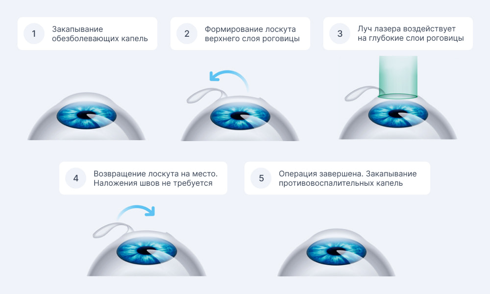 Этапы лазерной коррекции